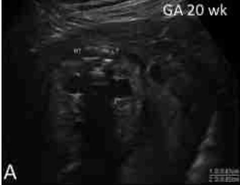 Εμβρυο 22+2 εβδομάδων . Εμφανίζεται διάταση 8 mm στον αριστερό νεφρό .